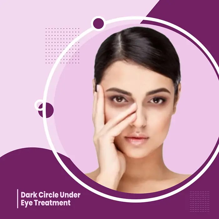 Dark Circles Under Eyes, Causes, Treatment