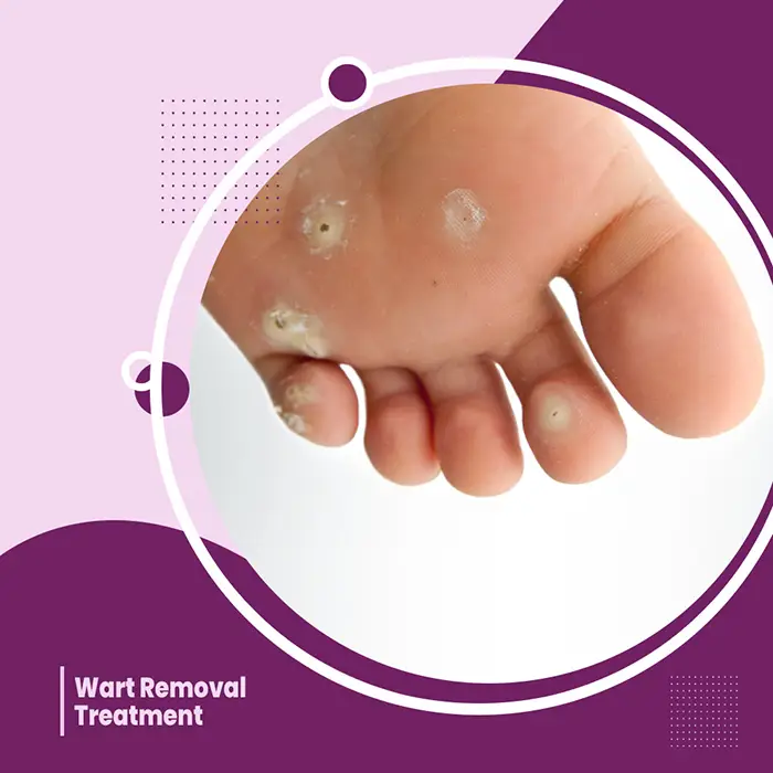 Wart Removal Treatment